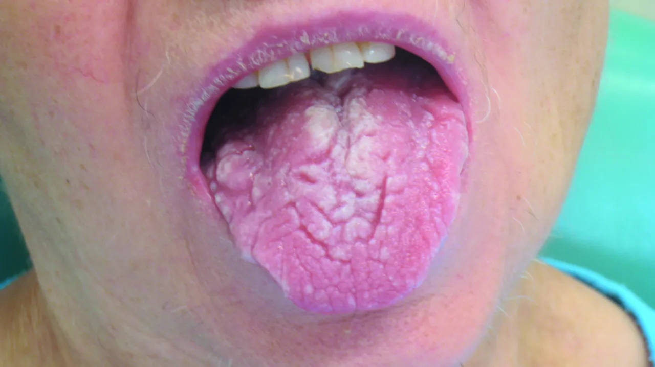 Zdjęcie Niedobory witamin objawy w jamie ustnej: nie ignoruj tych sygnałów