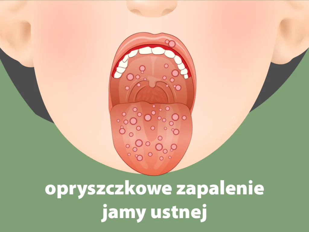 zapalenie jamy ustnej u niemowlaka objawy