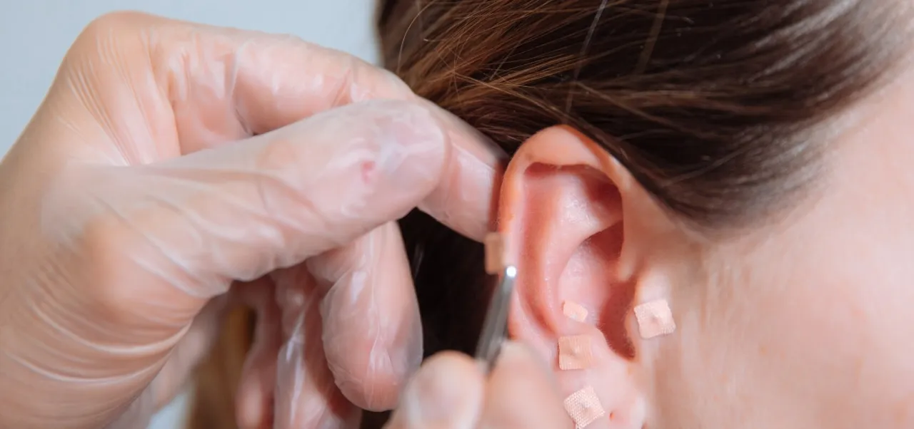 Akupunktura rzucanie palenia