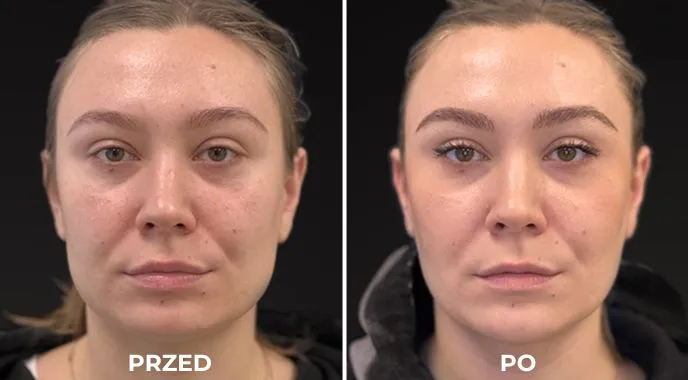 botox nieskuteczny rozczarowanie