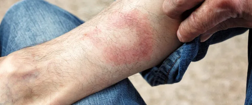 Nietypowy rumień wędrujący zdjęcia