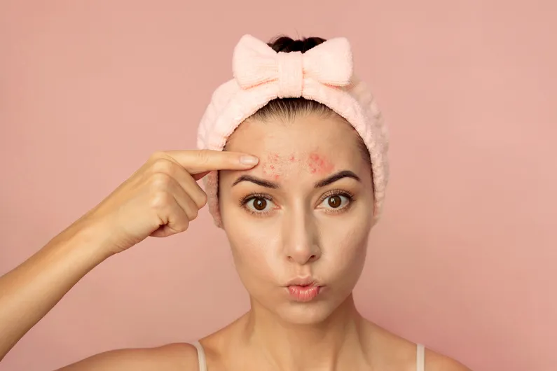 dieta na trądzik czoło