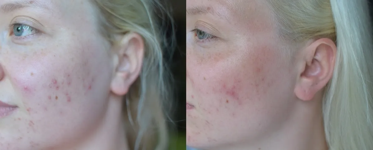 Prawidłowa aplikacja żelu punktowego na twarz