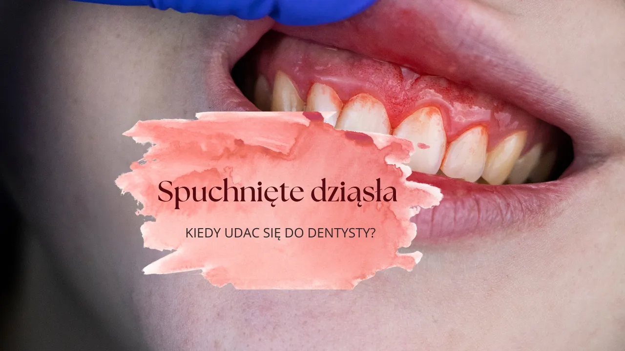 kiedy iść do dentysty ze spuchniętym dziąsłem