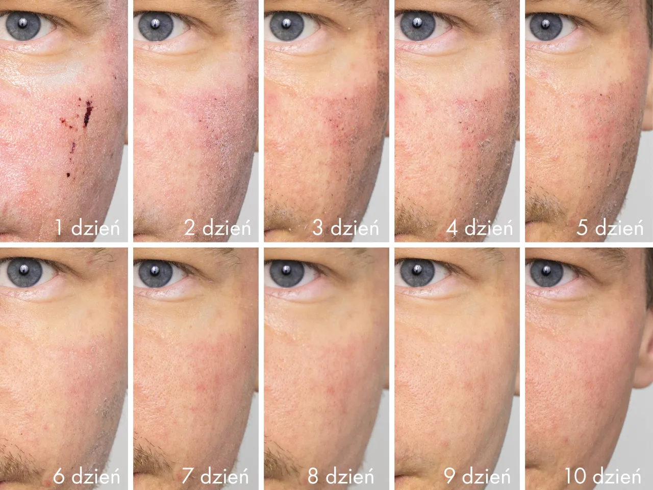 Laser frakcyjny mechanizm działania