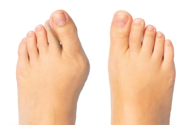 Ortopeda bada stopę z haluksem