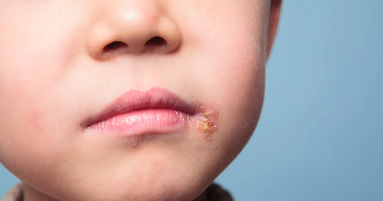 Etapy gojenia opryszczki u dziecka