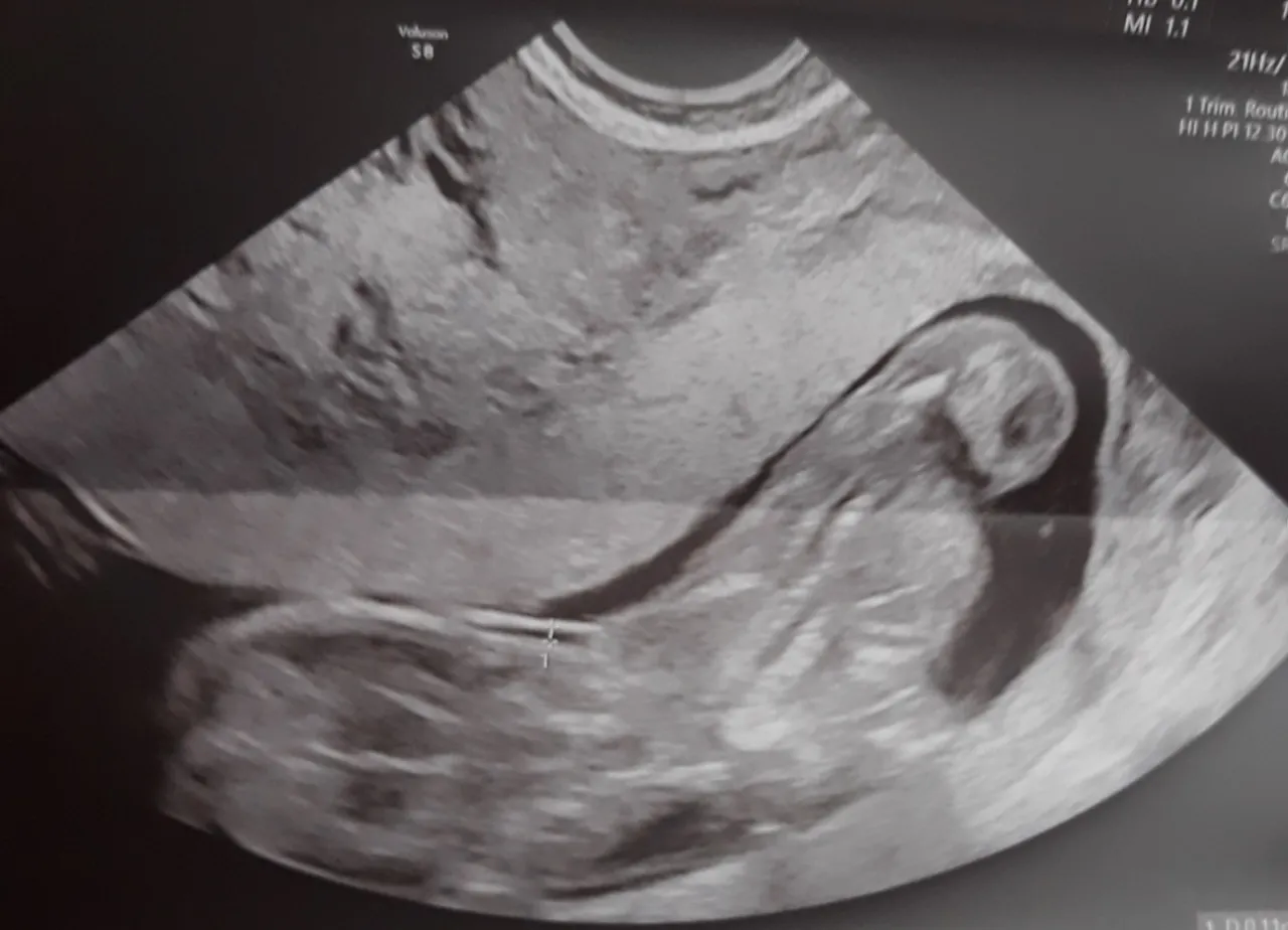 USG genetyczne 13 tydzień ciąży