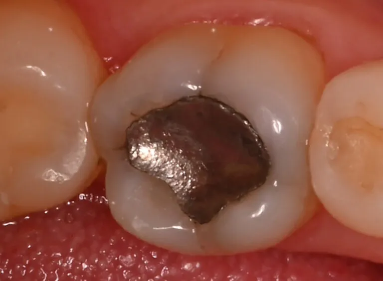 różne rodzaje wypełnień stomatologicznych