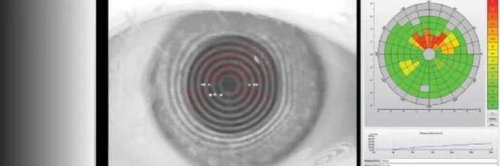 Wizualizacja anizometropii r&oacute;żnica w widzeniu między oczami