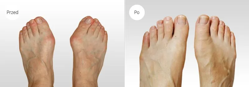 Etapy gojenia stopy po operacji haluksa infografika