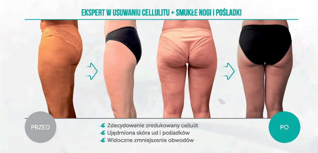 Efekty drenażu limfatycznego przed i po