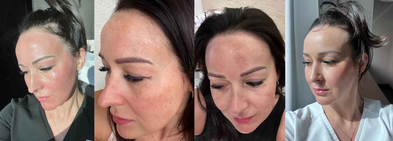 kobieta z gładką cerą po zabiegu laserowym