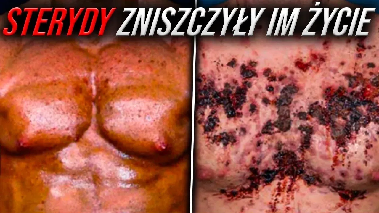 Negatywne skutki steryd&oacute;w na organizm człowieka grafika