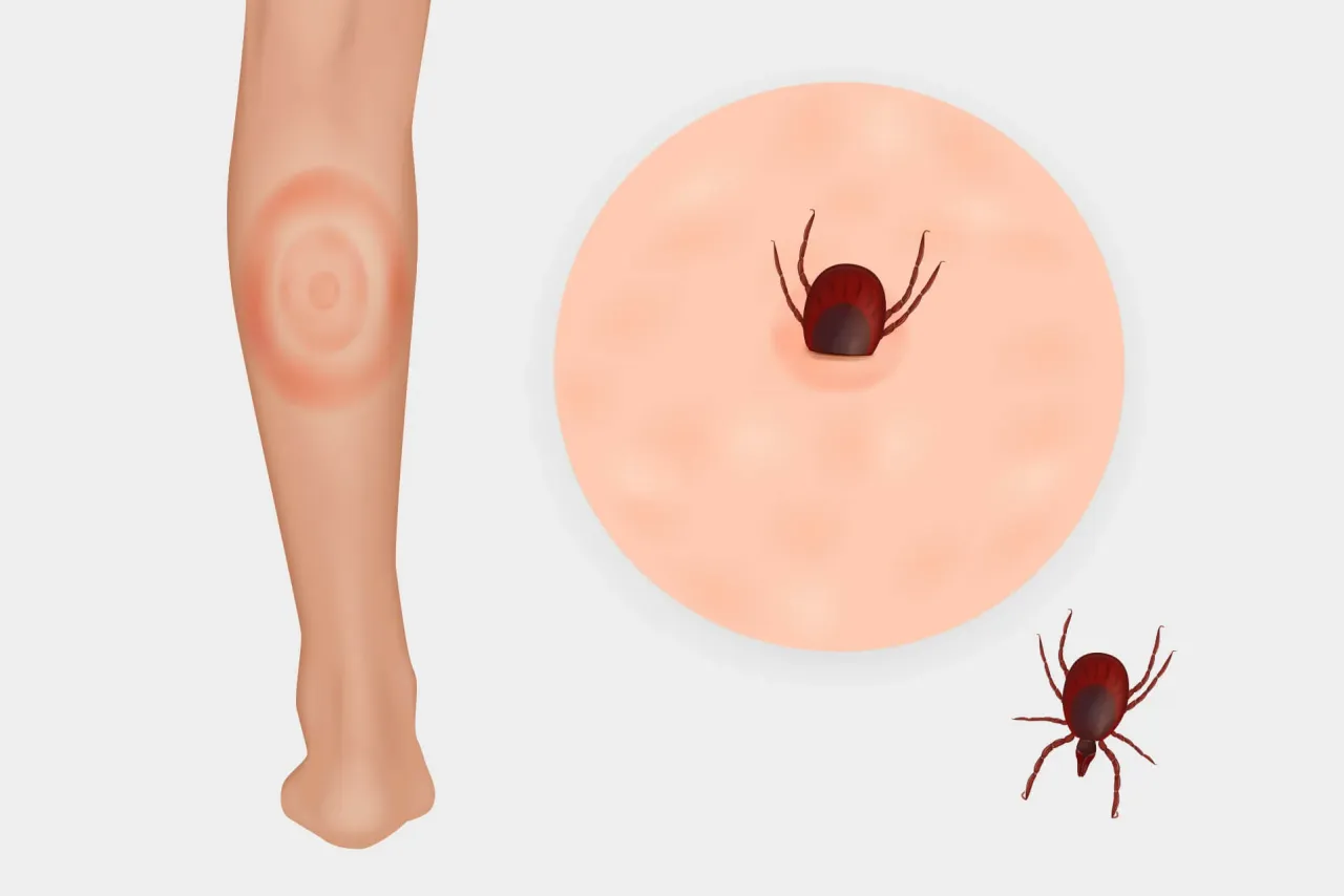 Rumień wędrujący borelioza zdjęcia