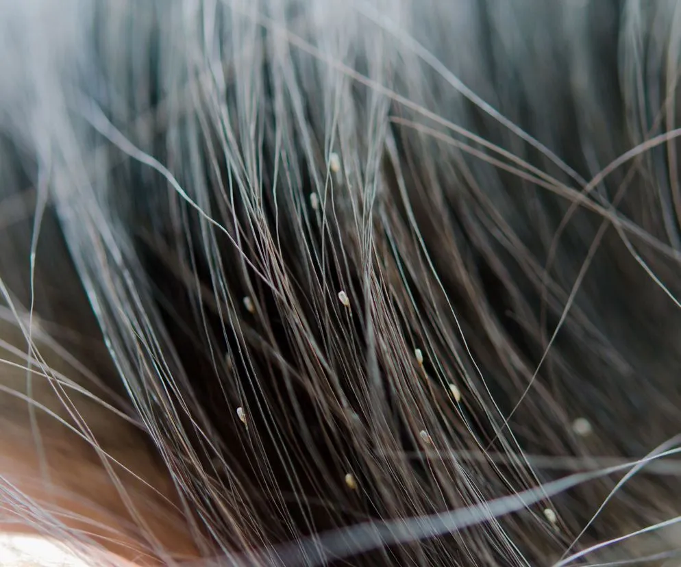 gnidy wszy na włosach