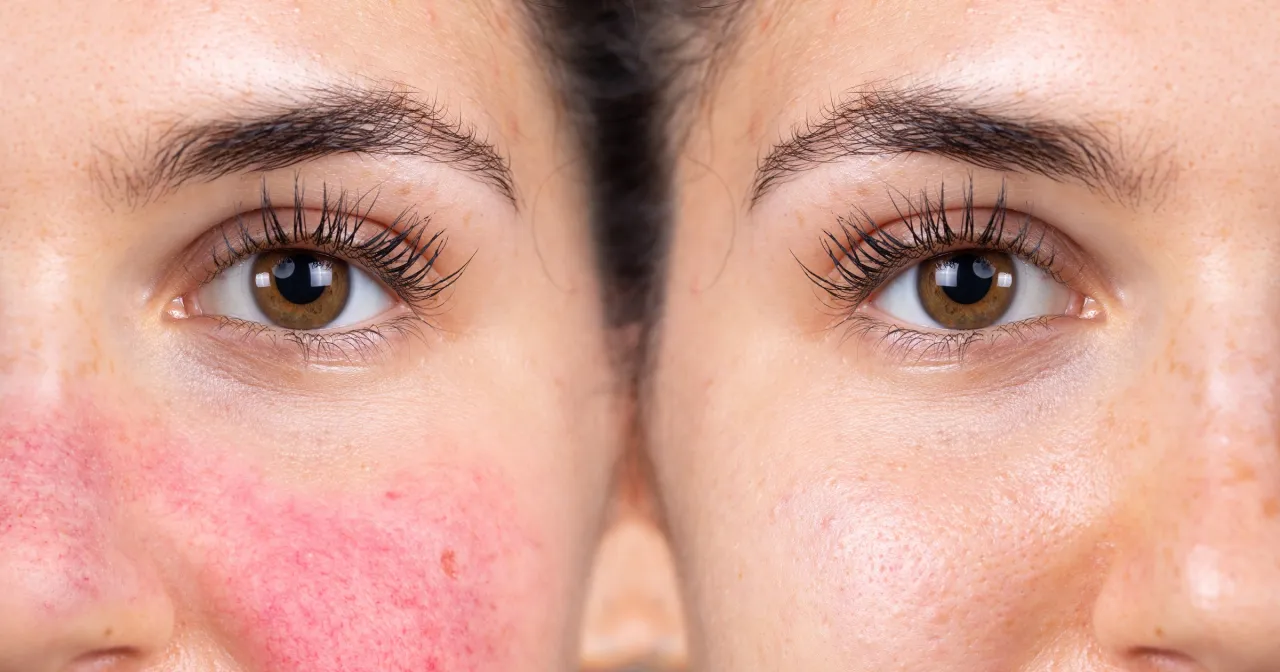 Przyczyny powstawania pryszczy na skórze