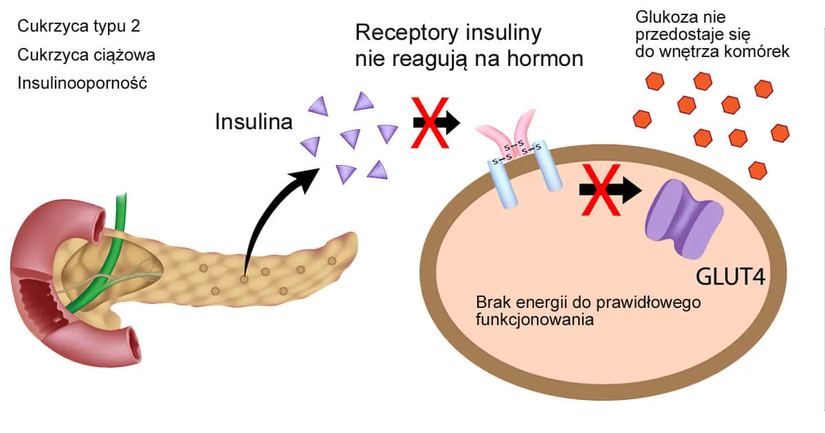 Schemat rozwoju insulinooporności i cukrzycy