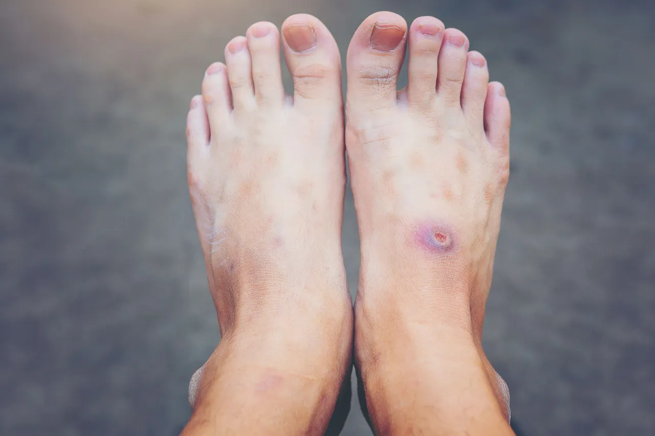 cukrzyca uszkodzenie nerwów stopy