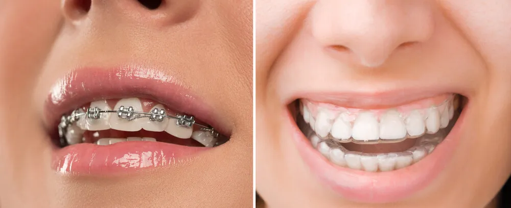 Rodzaje aparat&oacute;w ortodontycznych, por&oacute;wnanie estetyki i budowy