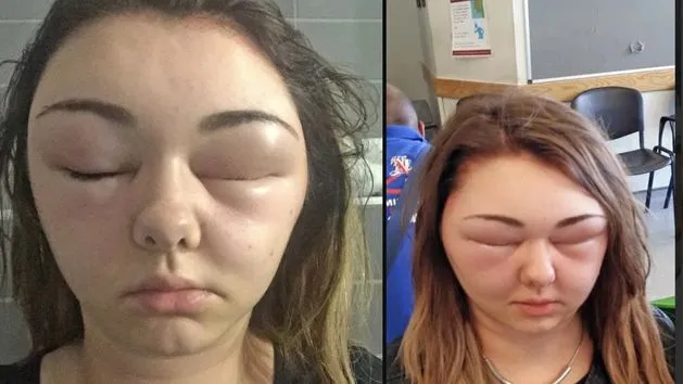 kobieta farbująca włosy w domu, zniszczone włosy po farbowaniu, reakcja alergiczna na sk&oacute;rze głowy