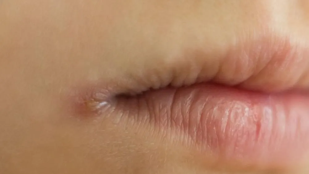 Pękające kąciki ust zajady