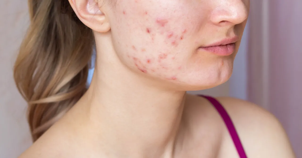 dermatolog wyjaśnia pielęgnację cery trądzikowej