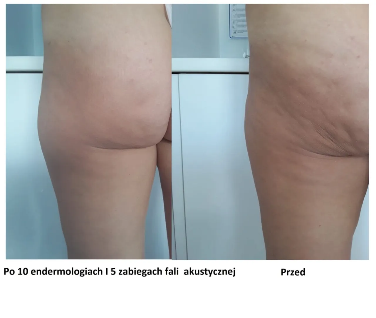 Profesjonalne zabiegi na cellulit przed i po