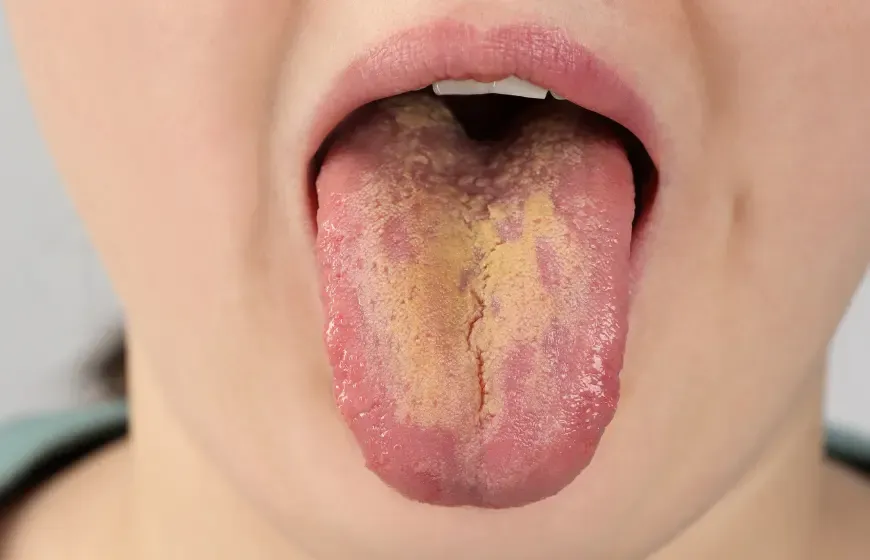 objawy chorób błony śluzowej jamy ustnej