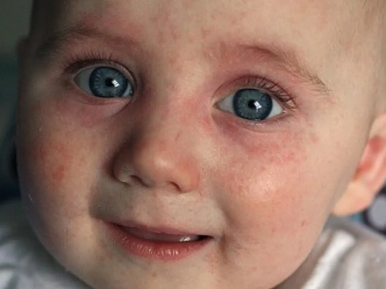 Niemowlę z zaczerwienionymi policzkami i suchą sk&oacute;rą