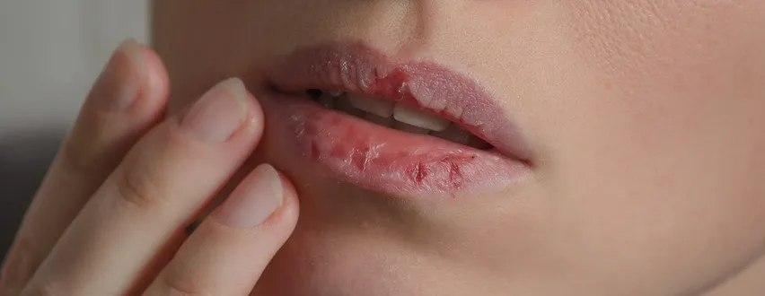 domowe sposoby na rany w ustach zioła sól