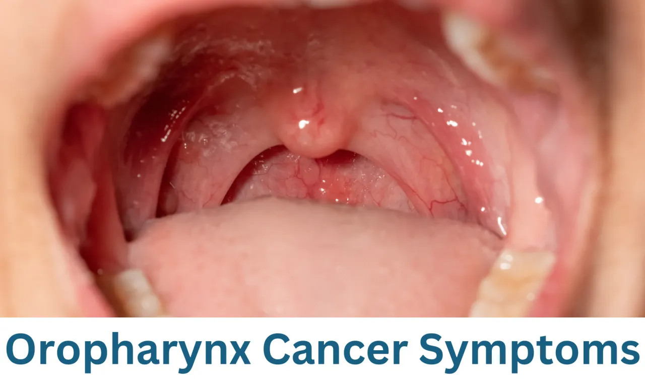 Rak gardła wczesne stadium