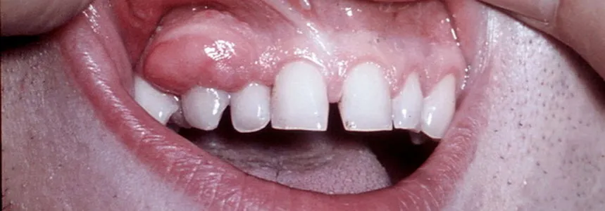 guz ciążowy nadziąślak