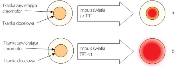 Rodzaje laser&oacute;w do depilacji schemat