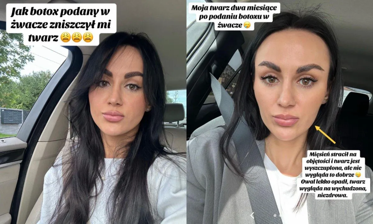 kobieta zrelaksowana twarz po botoksie