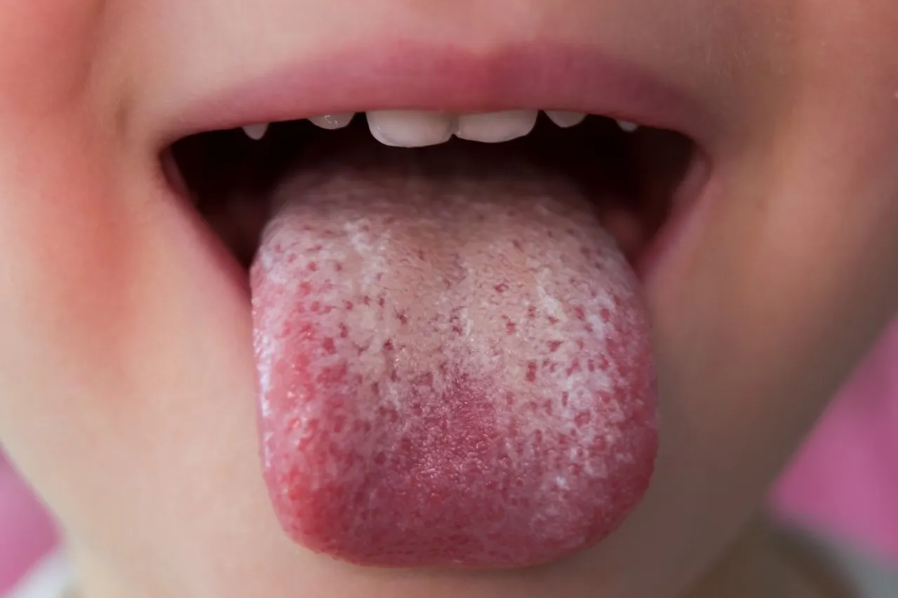 Grzybica jamy ustnej objawy nalot pleśniawki