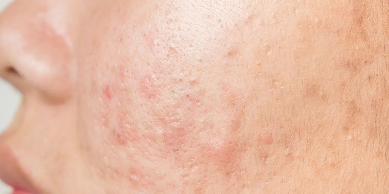 Osoba zamyślona, dotykająca twarzy z pryszczem, frustracja