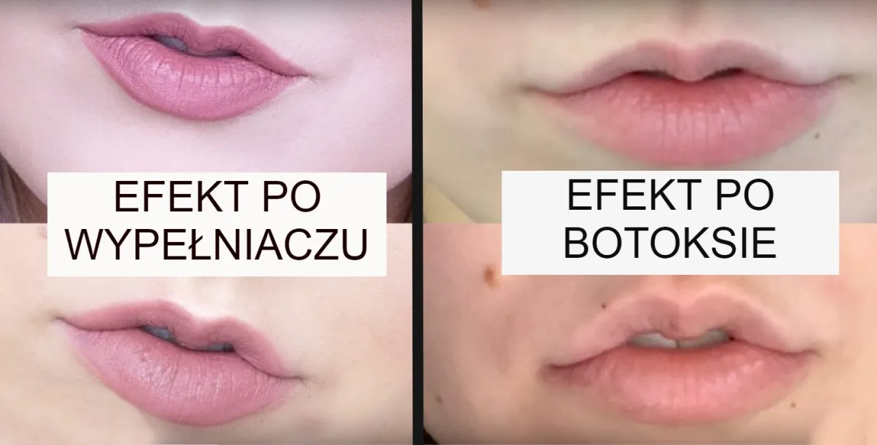 botoks usta lip flip vs kwas hialuronowy powiększanie r&oacute;żnice