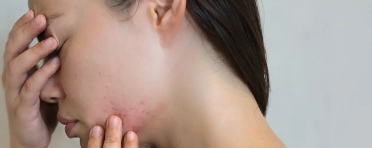 Stress und Hautgesundheit