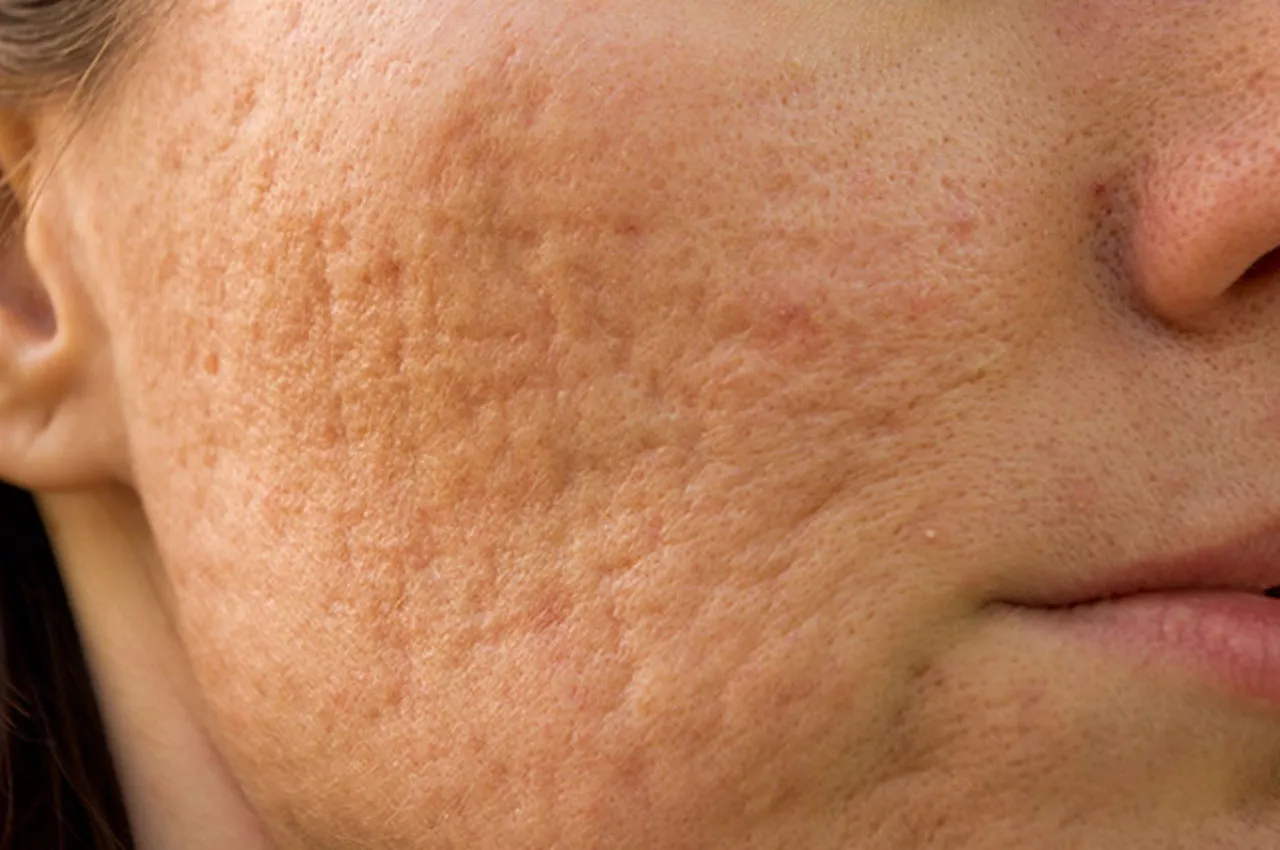 Skuteczne składniki na blizny potrądzikowe