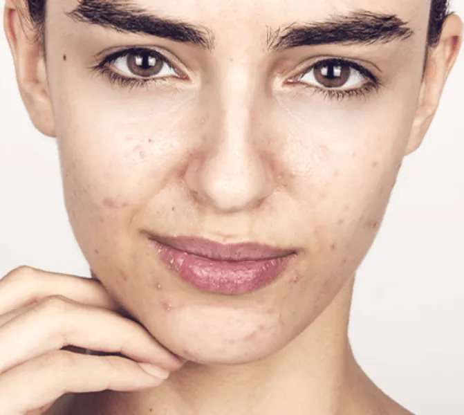 cera trądzikowa problemy skóra