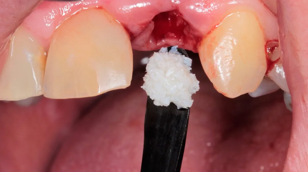 dentysta zakłada gazik po usunięciu zęba