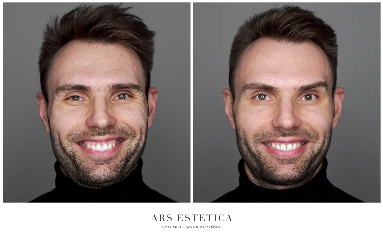 Lekarz wykonujący zabieg botoksu