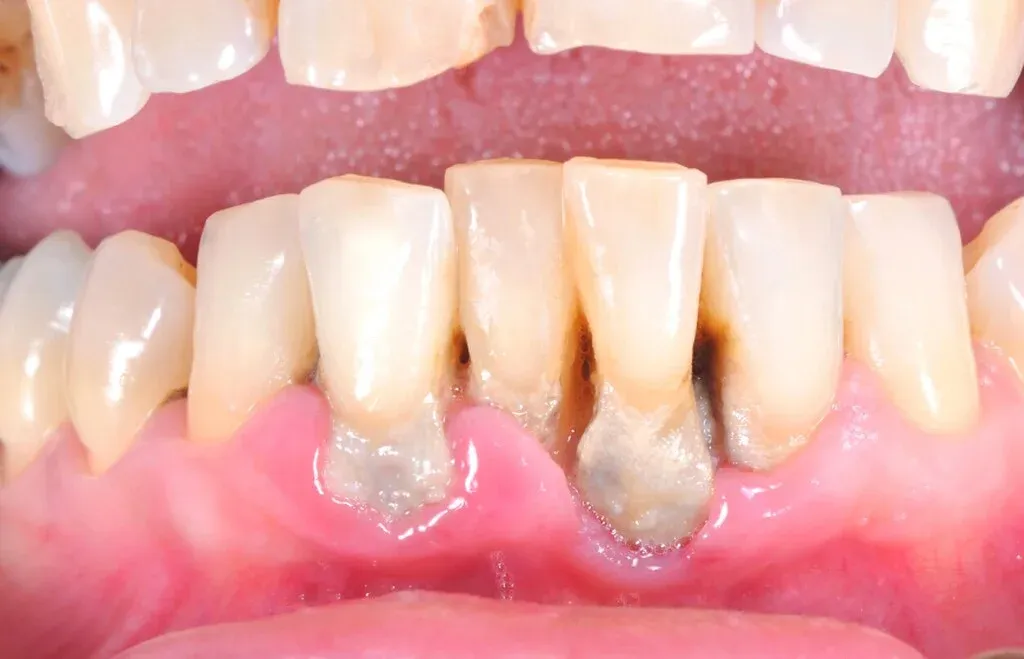 Płytka nazębna vs zdrowe dziąsła
