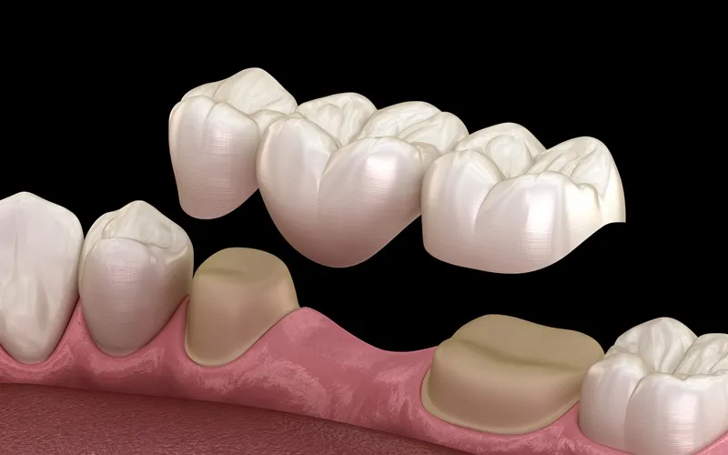 Mosty protetyczne porównanie wyglądu metalowo-porcelanowe pełnoceramiczne