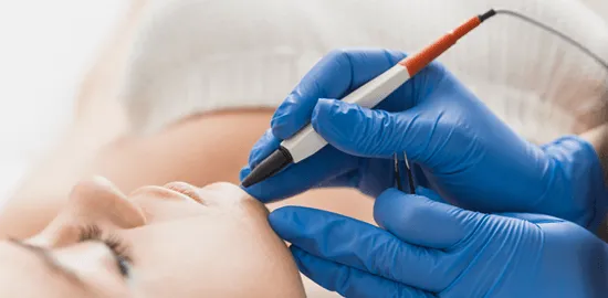 depilacja laserowa twarzy, elektroliza