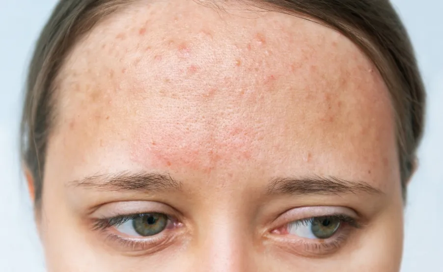 Kobieta z trądzikiem hormonalnym na twarzy