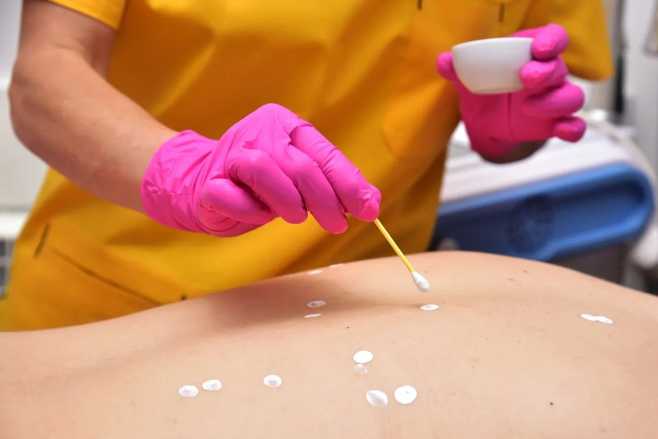 maść cynkowa i plasterki hydrokoloidowe