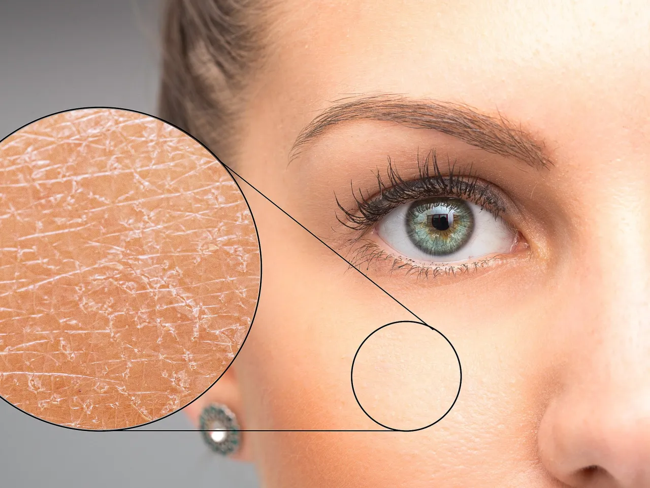 Hautkrankheiten Gesicht Vergleich Rosazea Neurodermitis seborrhoisches Ekzem