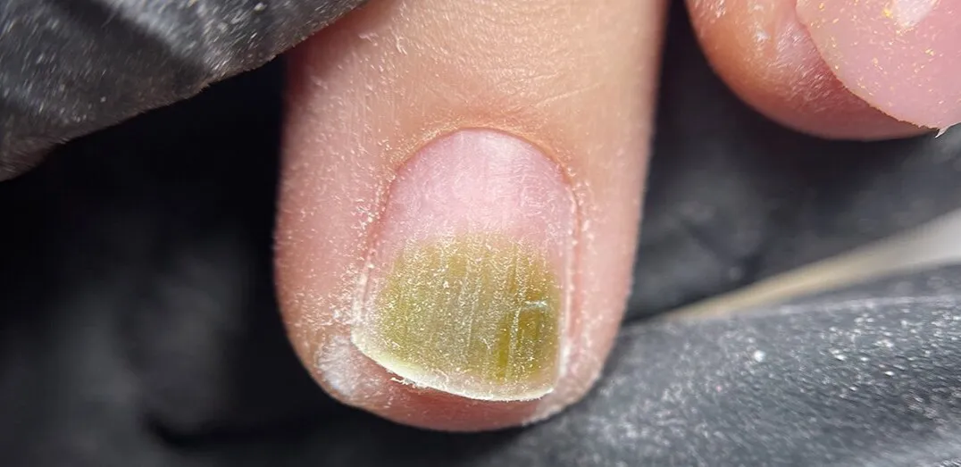 Zdjęcie Zielona plama na paznokciu: leczenie, przyczyny i jak odr&oacute;żnić od grzybicy